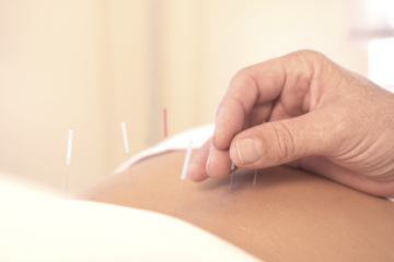 Acupuncture Treatments at Edinburgh’s Trusted Clinic for Acute & Chronic Pain